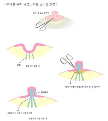 함몰유두 수유가 걱정된다면 3