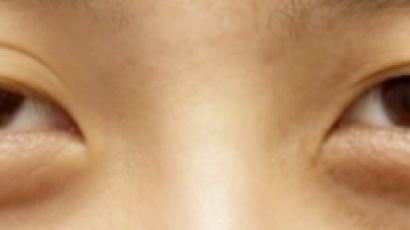 [최홍림원장의 눈매교정칼럼]쌍꺼풀수술, 눈뜨는 근육 살펴야 재수술 막는다