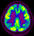 알츠하이머성 치매 때문에 세포가 손상된 뇌는 파란색 부위가 많다. [중앙포토]
