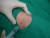 퇴행성 관절염 환자의 무릎부위에 스테로이드주사(뼈주사)를 놓고 있다. [중앙포토]