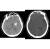 뇌출혈(왼쪽), 뇌경색(오른쪽) 환자의 CT 사진. [사진 서울아산병원]