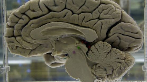 워싱턴대 연구팀 “뇌 외상 잦으면 치매 위험 최대 1.8배 높다”