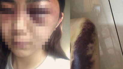 “피떡된 나를 또…” 광주 데이트폭력 피해자가 SNS에 올린 글