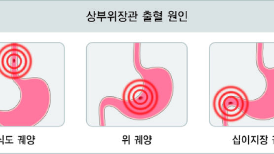 장 출혈 환자 급증…환자 대부분 40대 이상