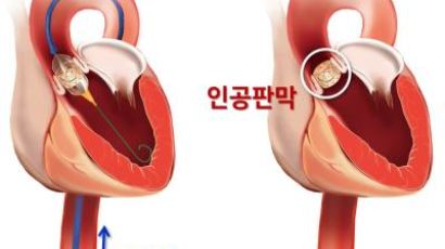 고령에 많은 ‘대동맥판막협착증’ 가슴 안 열고 치료