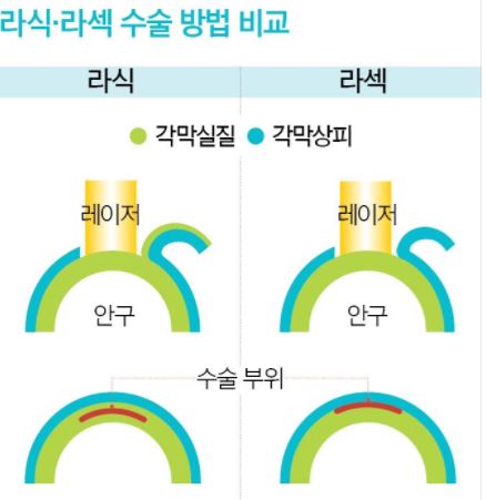 스마일 라식, 콘투라 비전, 엑스트라 라식. 내게 맞는 수술법은 무엇? | 중앙일보