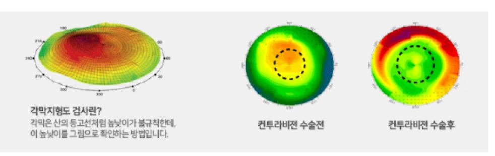 스마일 라식, 콘투라 비전, 엑스트라 라식. 내게 맞는 수술법은 무엇? | 중앙일보