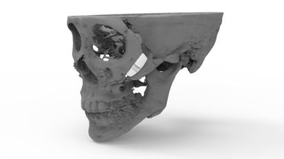 국내 최초 바이오 소재로 만든 3D프린팅 '인공광대뼈' 개발 