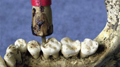 9000년 전 인류도 치과 치료 받았다