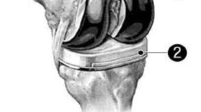 [Family건강] 금속 대신 세라믹 … 오래 가는 무릎 인공관절 선봬