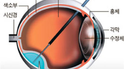 영국 연구진 “유전자 치료법으로 시력 회복”