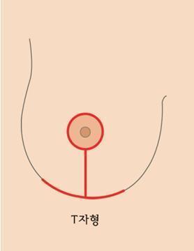 가장 고 난이도의 가슴성형, 가슴축소의 비밀 | 중앙일보