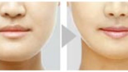 [페이스 디자인] 주걱턱 환자 ‘선 수술, 후 교정’으로 효과 높여 