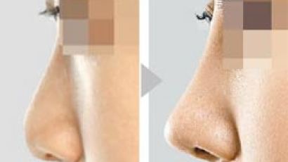 [페이스 디자인] 콧대 섣불리 높였다가 코 모양 망칠 수 있어요