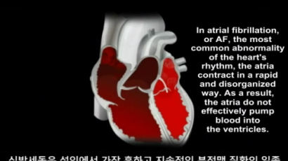 아태지역 심장 전문의들, 심방세동으로 인한 뇌졸중 위험 경고
