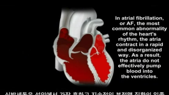 아태지역 심장 전문의들, 심방세동으로 인한 뇌졸중 위험 경고