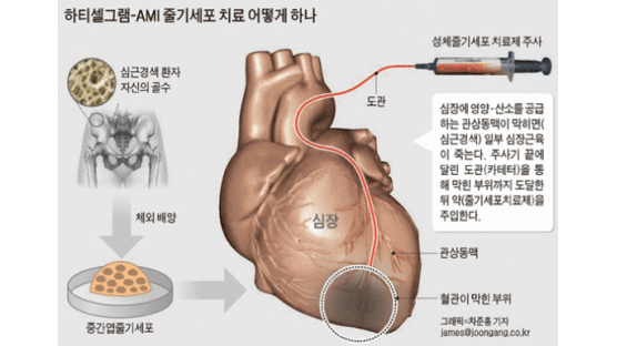 심장 혈관에 ‘줄기세포 치료제’ 넣어 심근경색 고친다