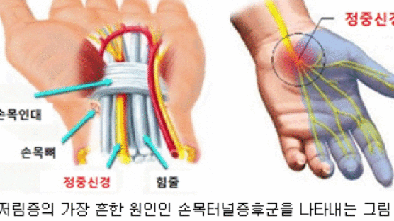 [건강 칼럼] '찌릿찌릿' 손 저릴 때 참지 마세요 