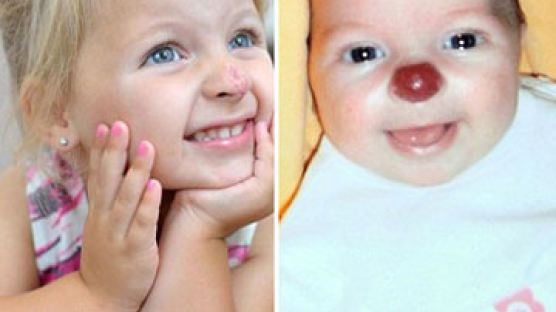 아기 코가 루돌프 코? 빨간 코 가지고 태어난 아기 "엄마처럼 되고 싶어…" 