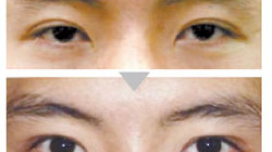 [페이스 디자인] 눈꺼풀 졸려보일 땐 안검하수 교정술