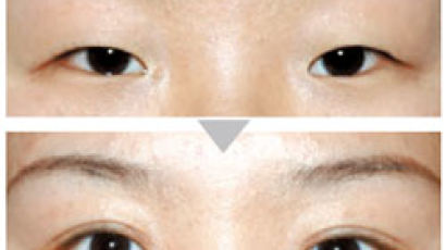 [페이스 디자인] 눈두덩 지방 많아 두툼한 눈…매몰법 수술 고집하면 곤란 