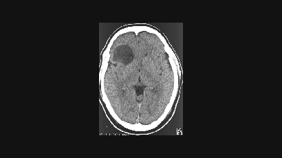 [헬스코치] 일반 뇌종양과 치료원칙 다른 최악의 뇌종양은?