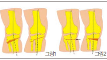 무릎 벌어진 O자형 다리 퇴행성 관절염 빨리 올 수도