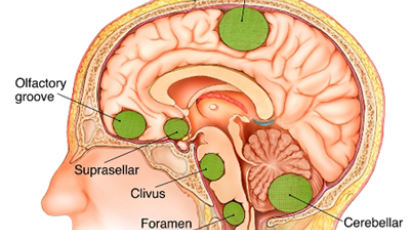 [헬스코치] 뇌수막종이 흔한 뇌종양이라고?