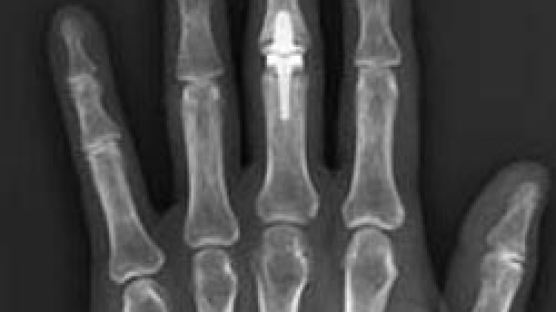[병원리포트] 중년 여성들 ‘손가락 관절염’에 취약