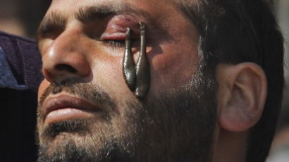 눈두덩에 거머리를…인도 전통치료법 '깜짝' 
