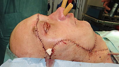 [사진] 사고 후 곧바로 안면이식 수술한 폴란드 남자