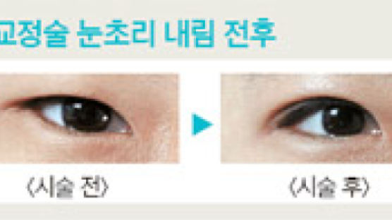 [레알 뷰티 톡톡] 눈매 모양 교정하는 뒤·밑트임 수술