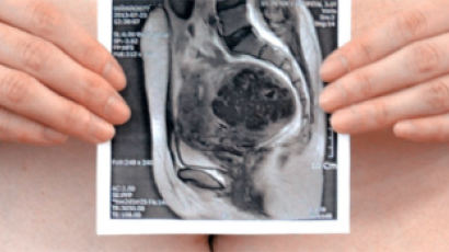 통증 오면 "살려달라" … 자궁근종에 출산도 직장도 포기