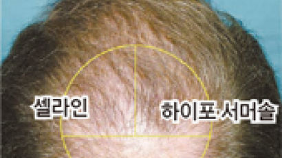 [이런 치료법] 옮겨 심은 머리카락, 98%까지 살리는 비법 있었네