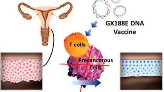 자궁경부전암 유전자치료백신 국내 연구진이 개발