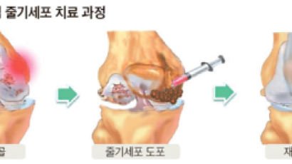 [증상으로 보는 관절질환] 무릎 퇴행성관절염, 줄기세포로 젊은 무릎 되살려