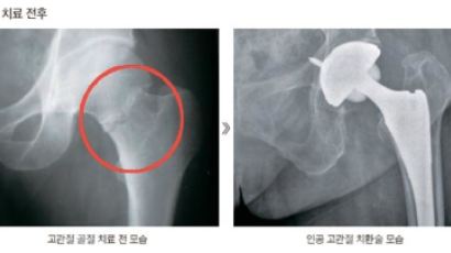 고관절 골절, 48시간 안에 수술받아야 회복 빨라