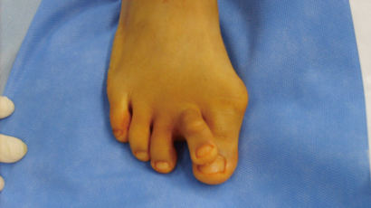 무지외반증 진단, 발가락이 휘어지는 증상…예방법은?