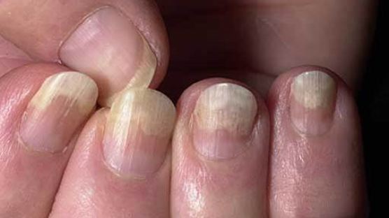 손톱으로 보는 건강, 하얘지면 간질환이고 회색줄 생기면 무좀이다?
