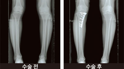 [병원리포트] 컴퓨터 기반 정교한 절삭 … 수술 후 5~7일부터 목발 보행