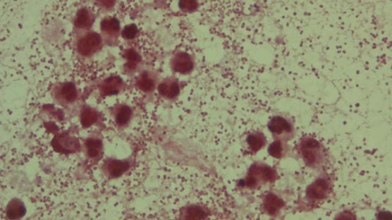 식인박테리아, 미국에서 처음 보고돼…현재는 일본에서 '비상'