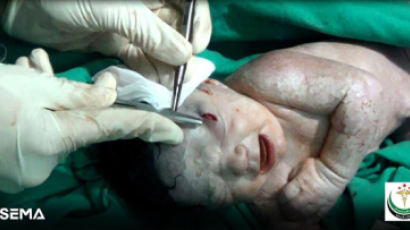 [국제] 태어나기도 전에 이마에 파편 박힌 시리아 아기