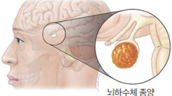 [이은직의 건강 비타민] 손발이 커지고 얼굴이 조금씩 변해요 … 뇌하수체 종양 의심을