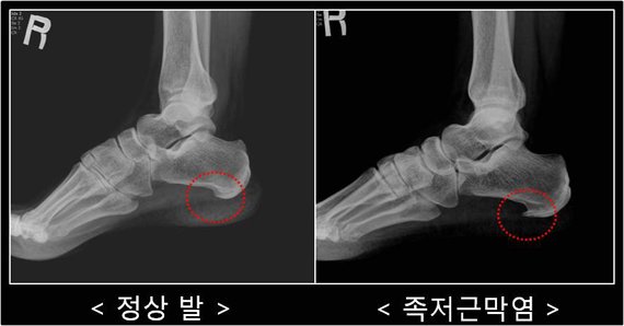 발 디딜 때마다 극심한 통증족저근막염 환자 운동 인구 증가로 5년새 두 배 중앙일보 