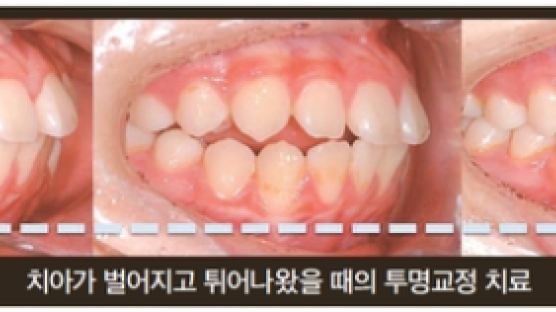 [건강한 가족] 김태원 원장의 ‘고른 이-밝은 미소⑤’ 튀어나오고 벌어진 이, 3D 교정으로 가지런히