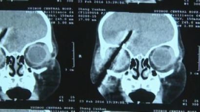 中여아 머리에 드라이버 7cm 꽂혀…아찔한 아동 사고