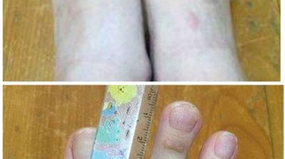 "발가락 길이가 5cm?" 대만 여성의 손가락만큼 긴 발가락 사진 화제