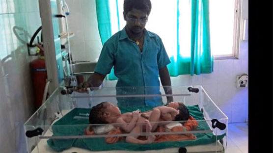 [사진] 인도서 태어난 남녀 접착 샴쌍둥이…산모 "검사했을 땐 몰랐다"