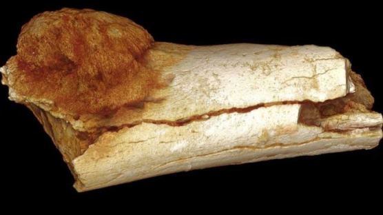 170만년 전 인류 조상 발뼈에서 종양 흔적 발견