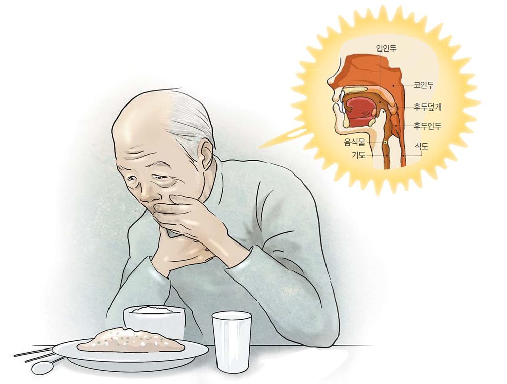 [건강한 당신] 음식 ‘꿀꺽’ 못 삼키면, 폐렴 걸려 사망 위험 높아진다 | 중앙일보